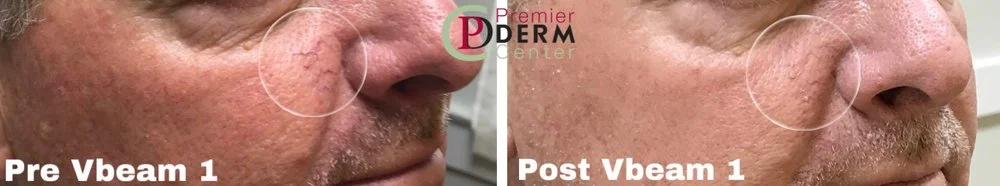 Veins and Red Spots Treatment ,Premier Derm Center PLLC | Houston, TX